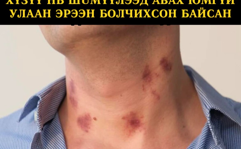 Хүзүү нь шимүүлээд авах юмгүй улаан эрээн болчихсон байсан...